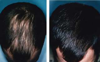 HAIR GROWTH PILLS* FAST RAPID LOSS REGROWTH EXTREMELY POWERFUL 